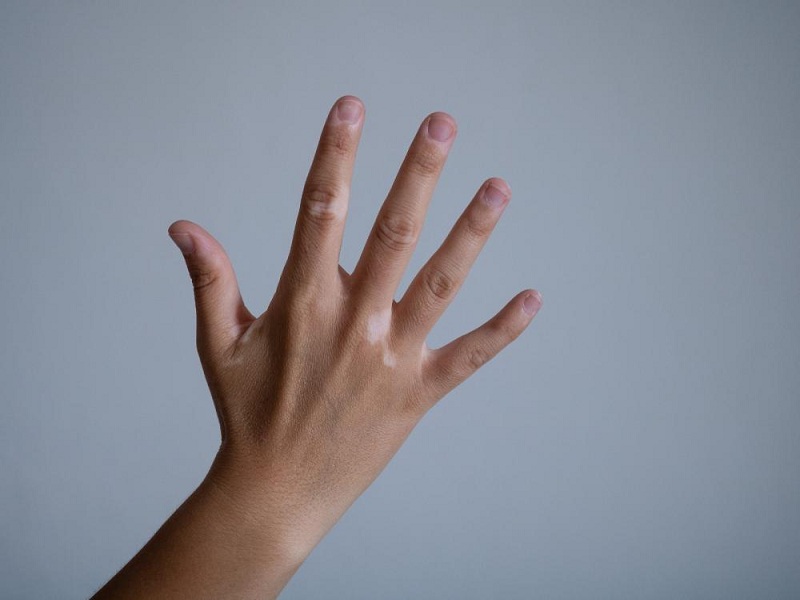 Non esistono terapie risolutive per curare la vitiligine ma ci sono diverse possibilità da seguire per migliorare la situazione: ecco quali sono