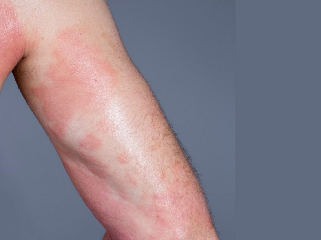 eczema atopico
