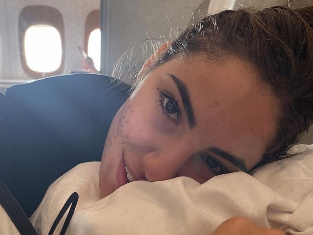 Giulia De Lellis racconta il suo calvario con l’acne