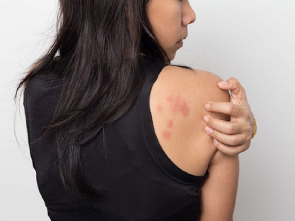 Il linfoma cutaneo a cellule T è una forma di tumore rara e che colpisce soprattutto la pelle: servono fino a 7 anni per una diagnosi corretta