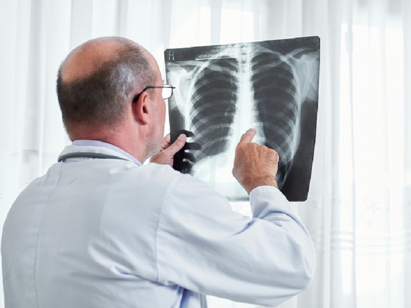 Carcinoma polmonare non a piccole cellule ALK-positivo: alectinib in adiuvante riduce recidive e decessi del 76%