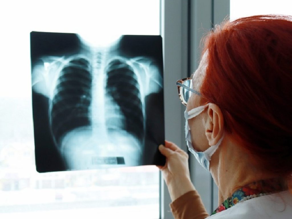 Interstiziopatia polmonare associata ad artrite reumatoide: l'impiego di metotressato è efficace contro mortalità e il declino della funzione polmonare