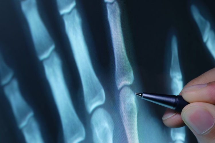 L'intelligenza artificiale utile per le diagnosi di artrite reumatoide e psoriasica: permette analisi più dettagliate sull'impiego dei farmaci utilizzati