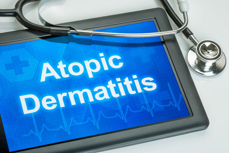 Dermatite atopica: miglioramento della malattia con minimi effetti collaterali dopo la terapia topica mirata contro lo Staphylococcus aureus