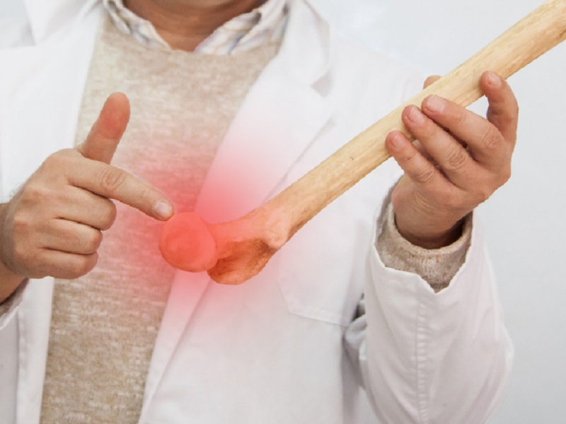 Osteoporosi e sarcopenia: fondamentale la prevenzione con un corretto stile di vita, attività fisica e acquisizione di calcio, proteine e soprattutto vitamina D