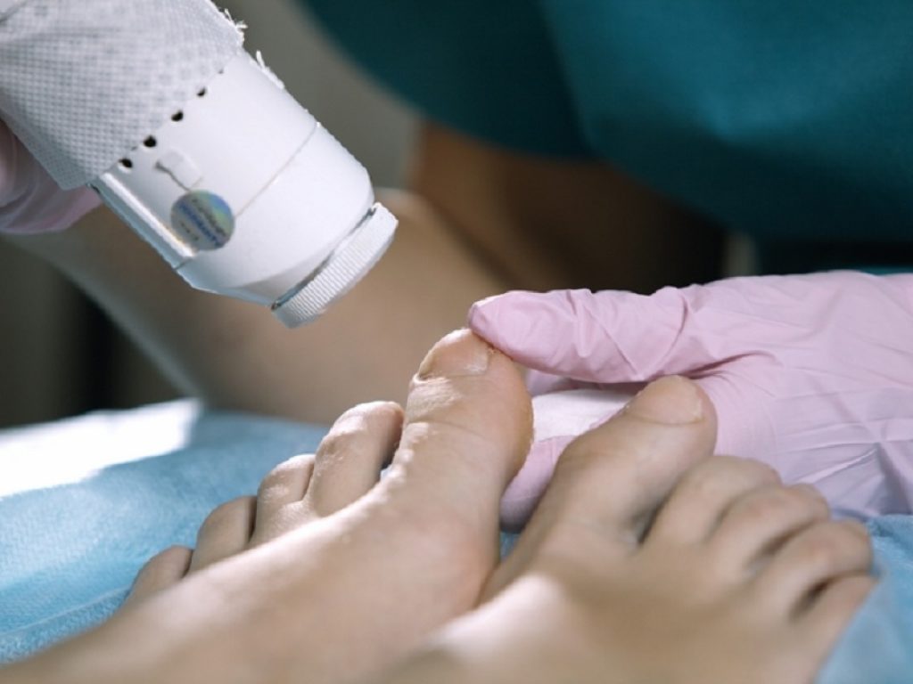 Onicomicosi dell'unghia del piede