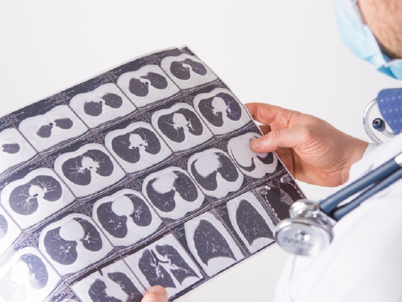 Tumore al polmone: test NGS nuova arma diagnostica