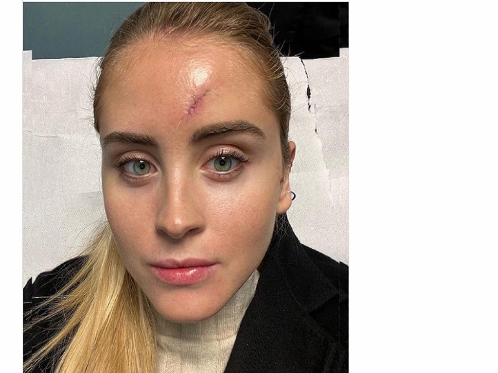 Valentina Ferragni, la sorella minore di Chiara e Francesca, si mostra sui social dopo l’operazione per un tumore maligno della pelle