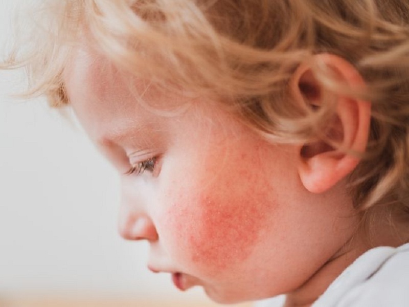 dermatomiosite tapinarof ciclosporina dermatite atopica sonno