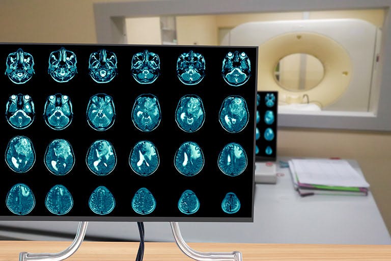 Glioblastoma: le cure giuste passano dalle cellule