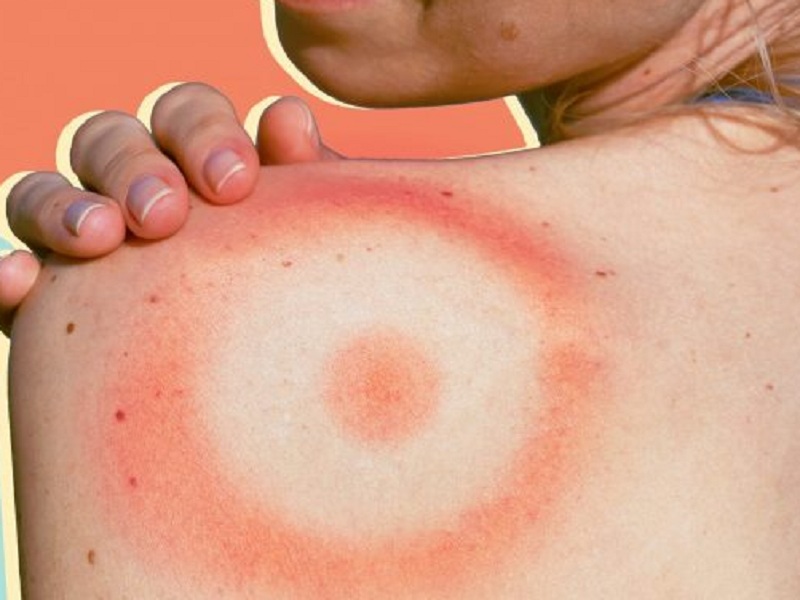 Malattia di Lyme: nasce il progetto BABEL per cure mirateil progetto BABEL per cure mirate