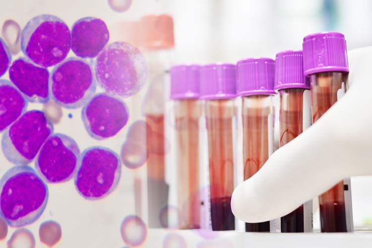 Linfoma di Hodgkin: Commissione UE ha approvato brentuximab vedotin in combinazione con doxorubicina, vinblastina e dacarbazina (AVD)