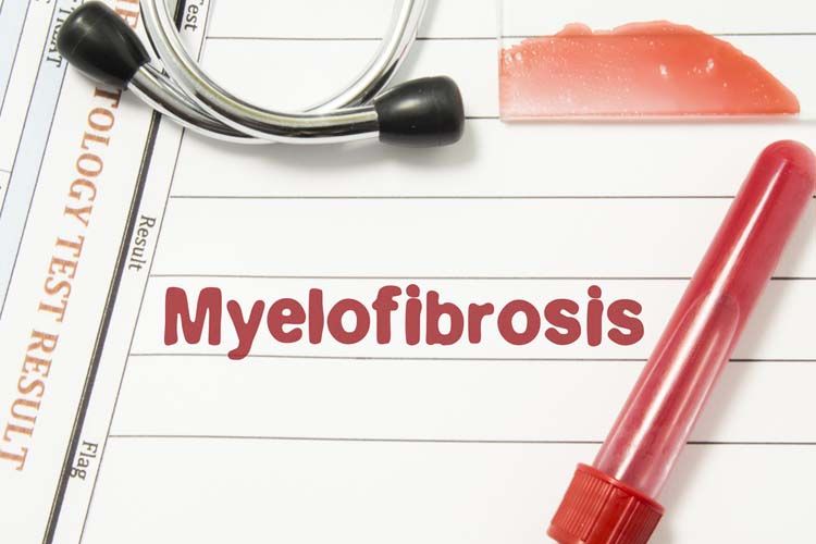 mielofibrosi trombocitopenica