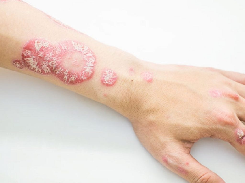 spevigo psoriasi pustolosa generalizzata