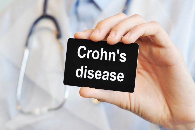calprotectina nutrizione enterale infliximab malattia di crohn fistole escherichia coli