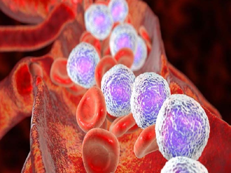 crisantaspasi leucemia linfoblastica linfociti granulati t