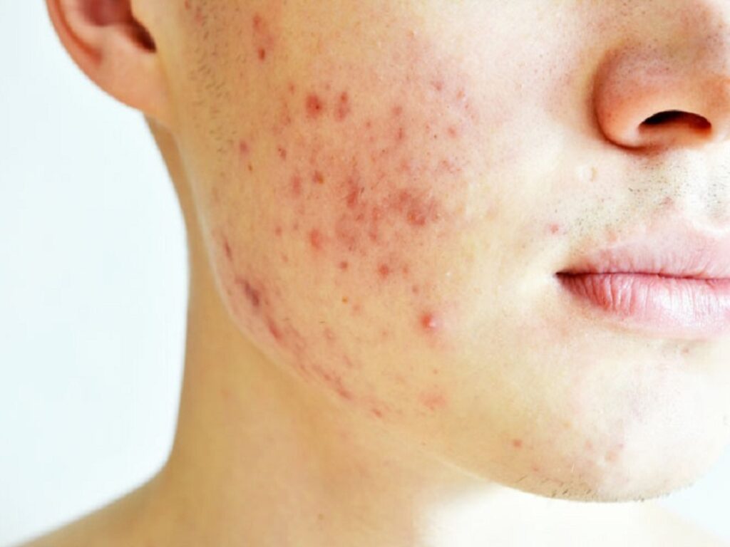 acne tazarotene botulino