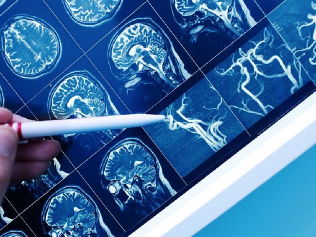 suzetrigina ibuprofene endotelina care neurologia neuroni dopaminergici