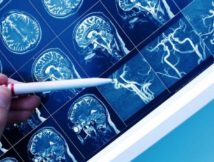 suzetrigina ibuprofene endotelina care neurologia neuroni dopaminergici