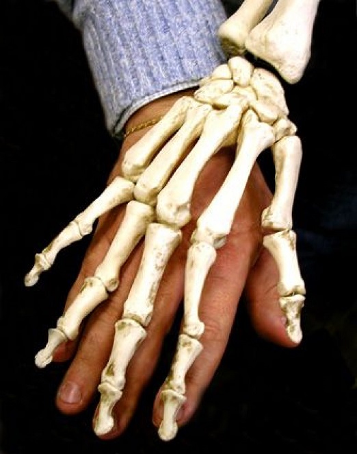 fibrodisplasia ossificante progressiva