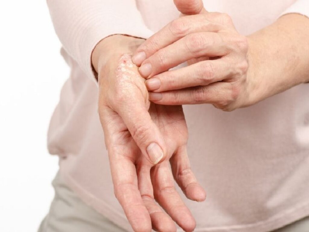 psoriasi Apiafco farmaci biologici