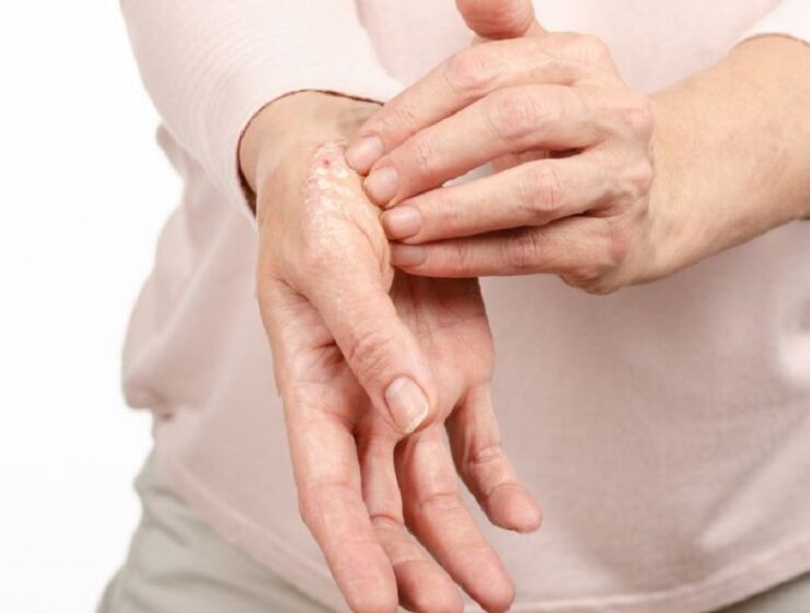 psoriasi Apiafco farmaci biologici