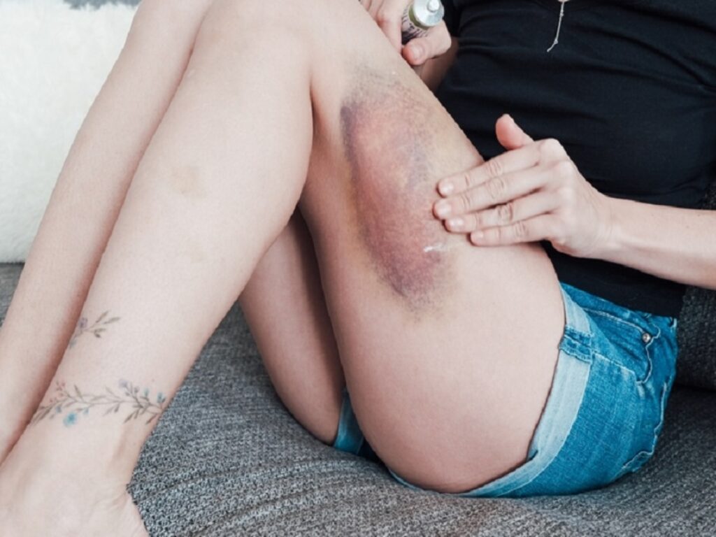 Sindrome da antifosfolipidi catastrofica