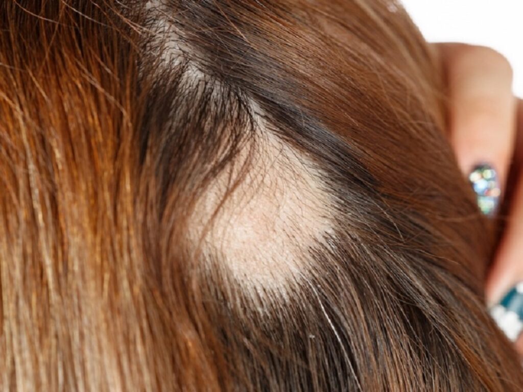 alopecia androgenetica donne