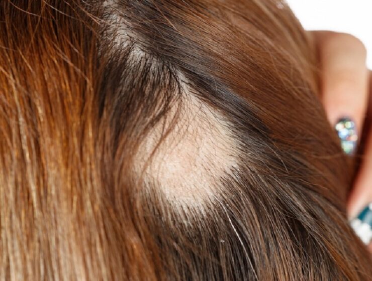 alopecia androgenetica donne