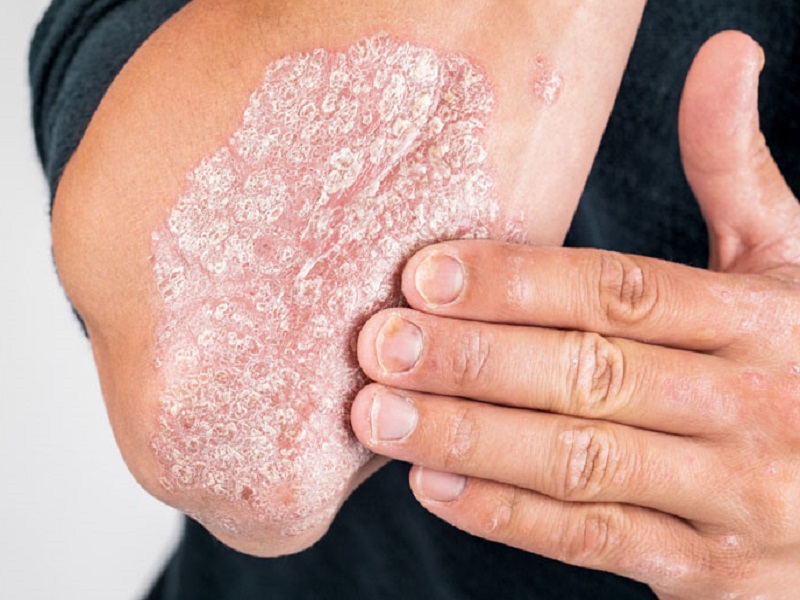 psoriasi bimekizumab fototerapia