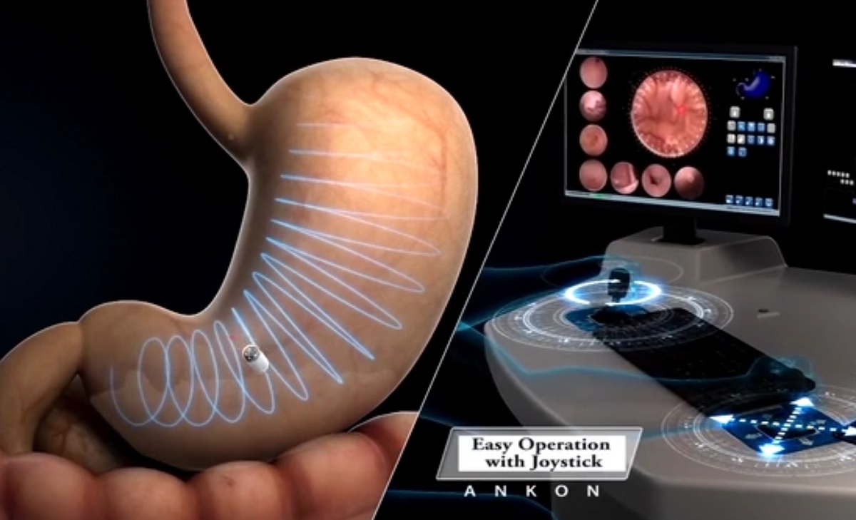 videocapsula gastroscopia