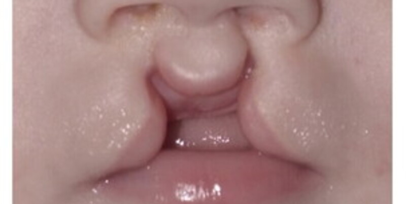 labiopalatoschisi