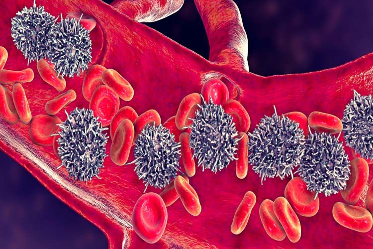 leucemia a cellule capellute
