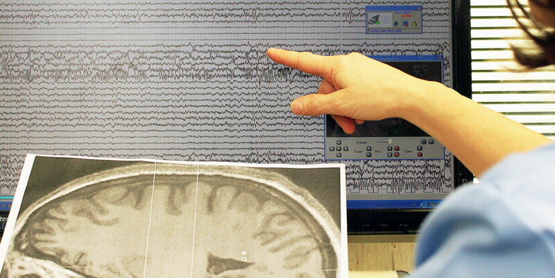 epilessia in età evolutiva
