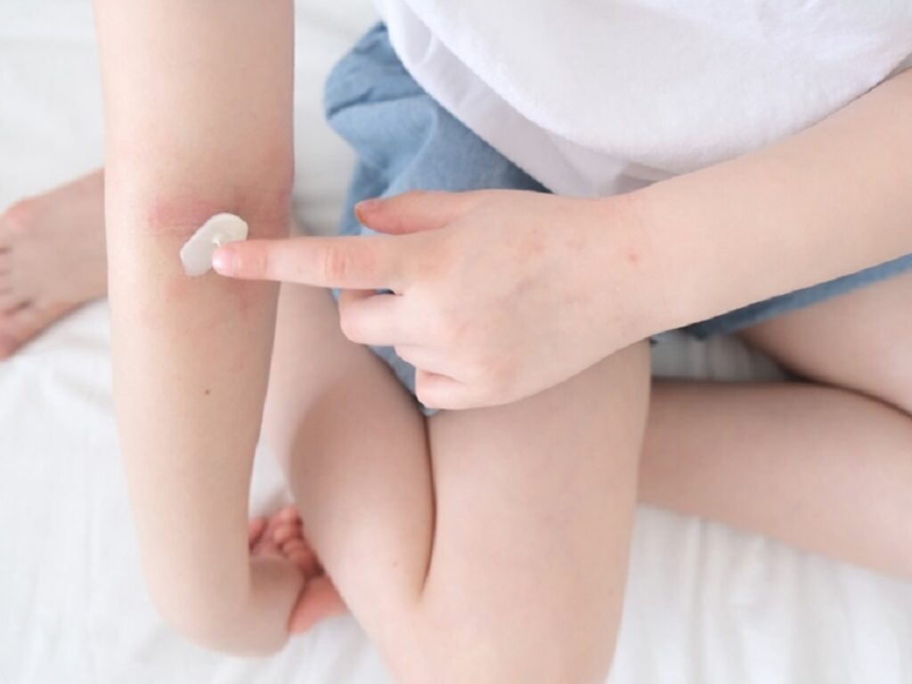 roflumilast topico fototerapia