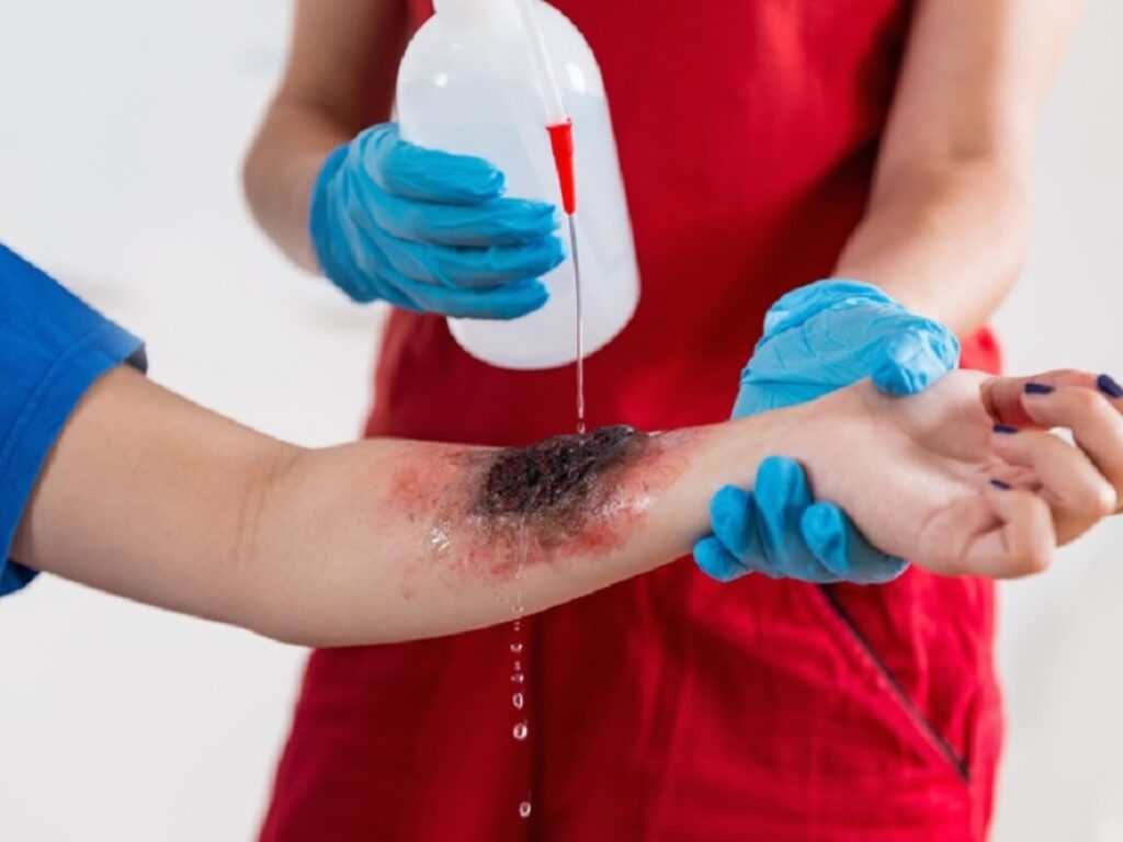 ustioni termiche gravi