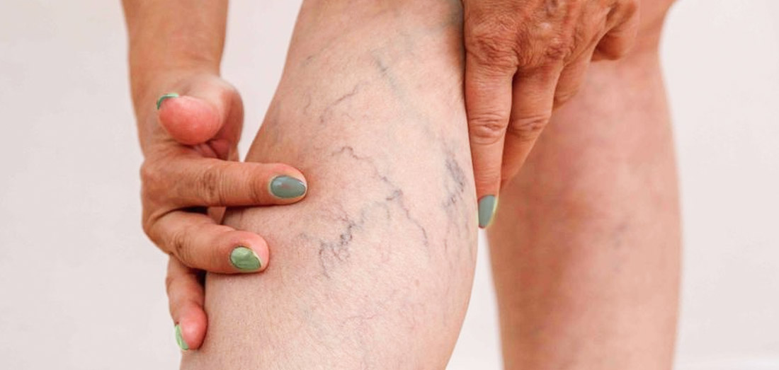 malattia venosa cronica