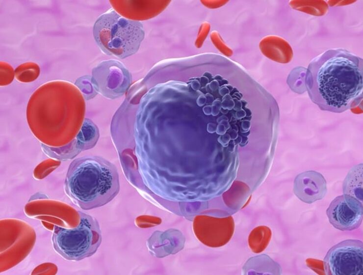 axicabtagene ciloleucel linfoma a grandi cellule