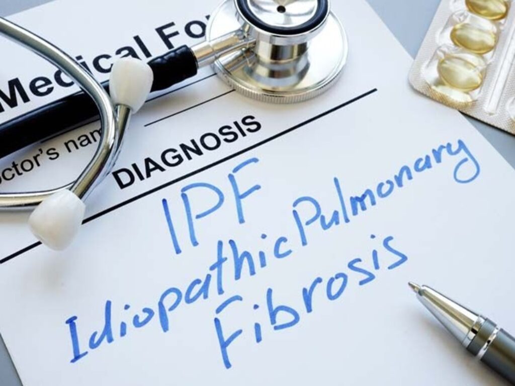 corticosteroidi fibrosi polmonare idiopatica pirfenidone