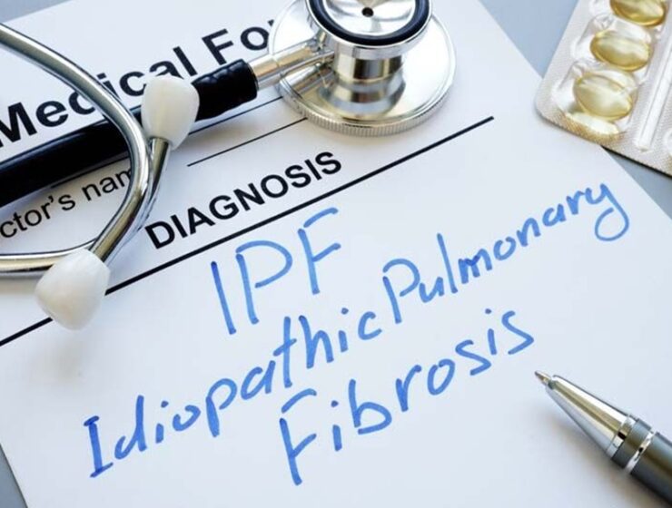 corticosteroidi fibrosi polmonare idiopatica pirfenidone