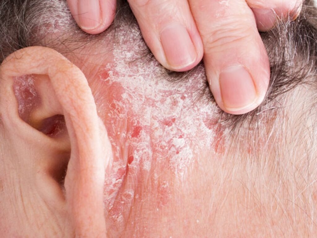 psoriasi del cuoio capelluto