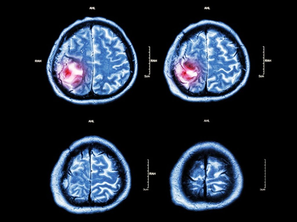 emorragia intracerebrale