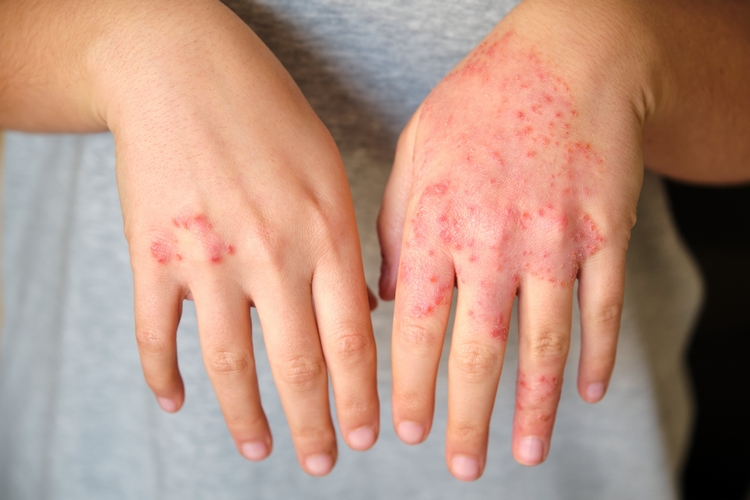 eczema cronico