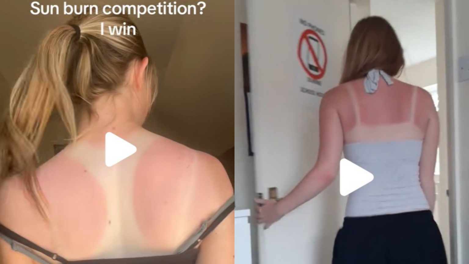 sunburn challenge