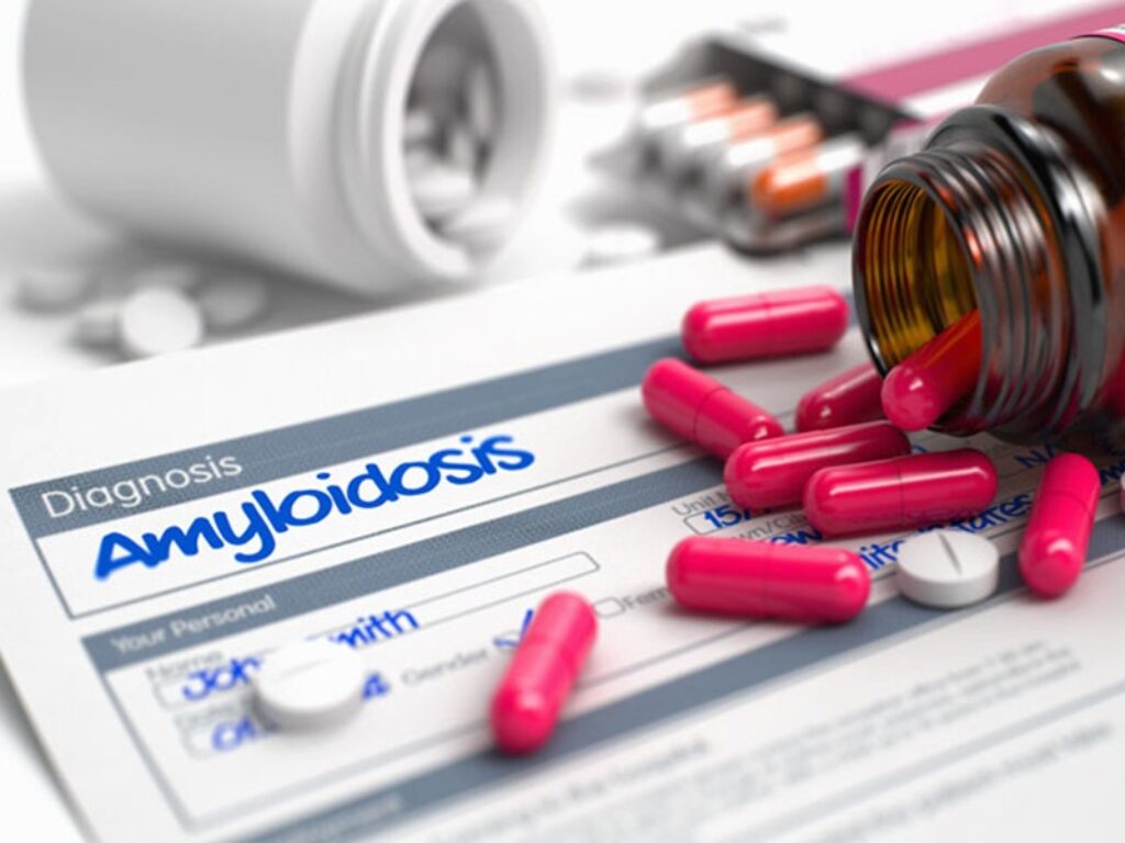 amiloidosi cardiaca
