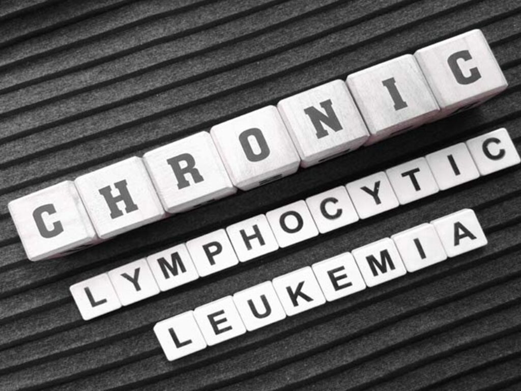 leucemia linfatica
