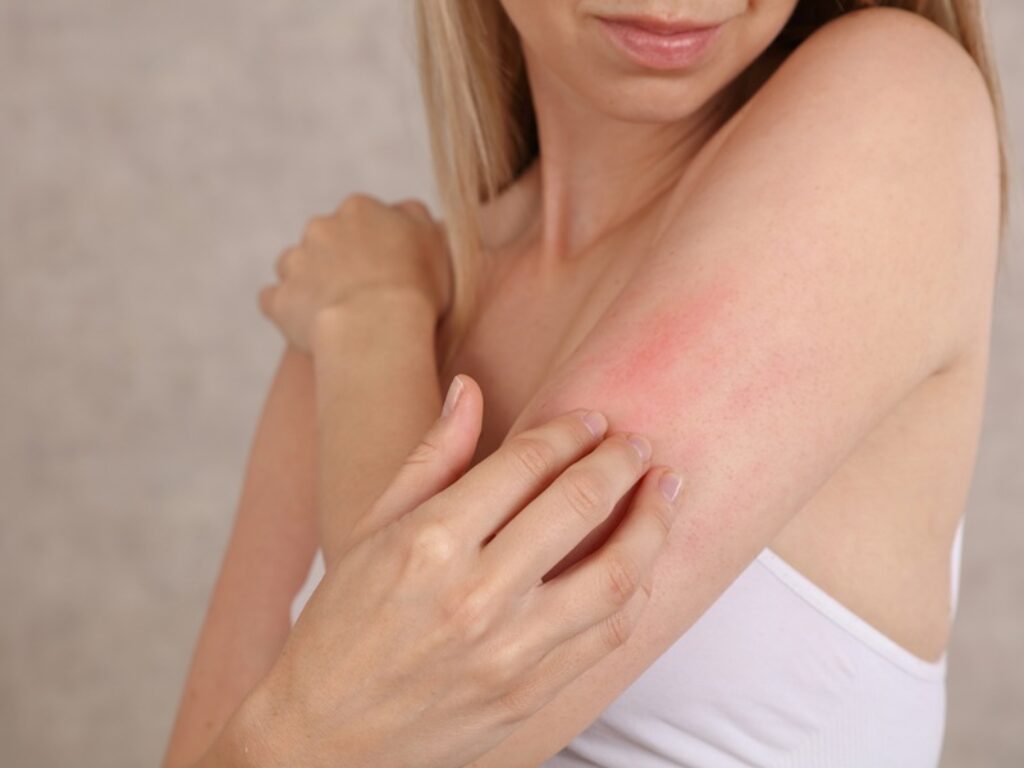 orticaria