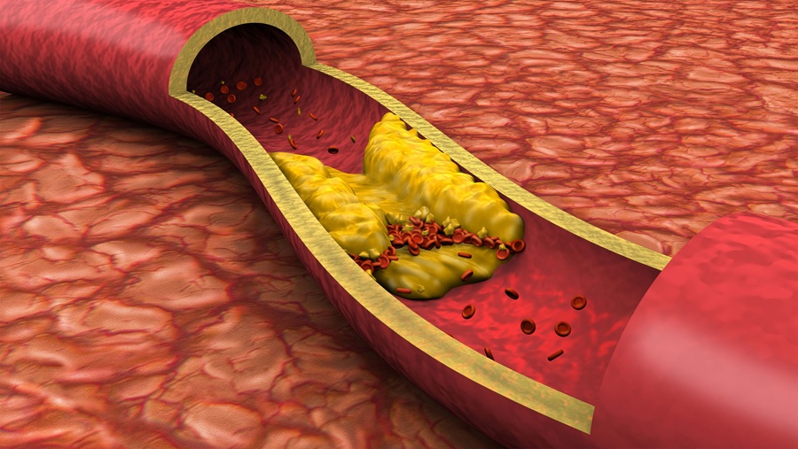 colesterolo ldl